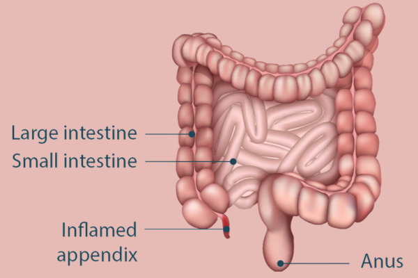 Appendicitis treatment hadapsar