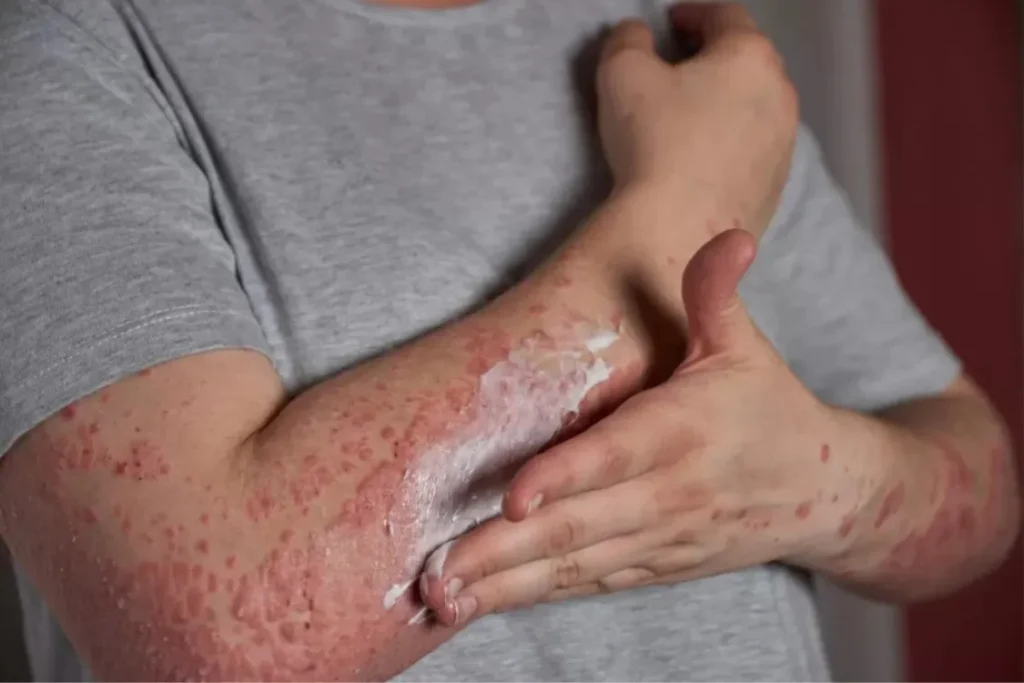 Burns & Reconstructive Surgery in Pune