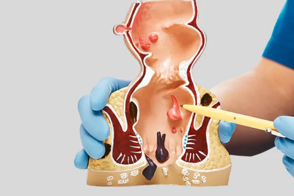 anal fissure treatment in pune