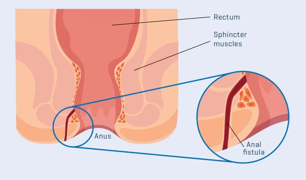 anal fistula treatment near me