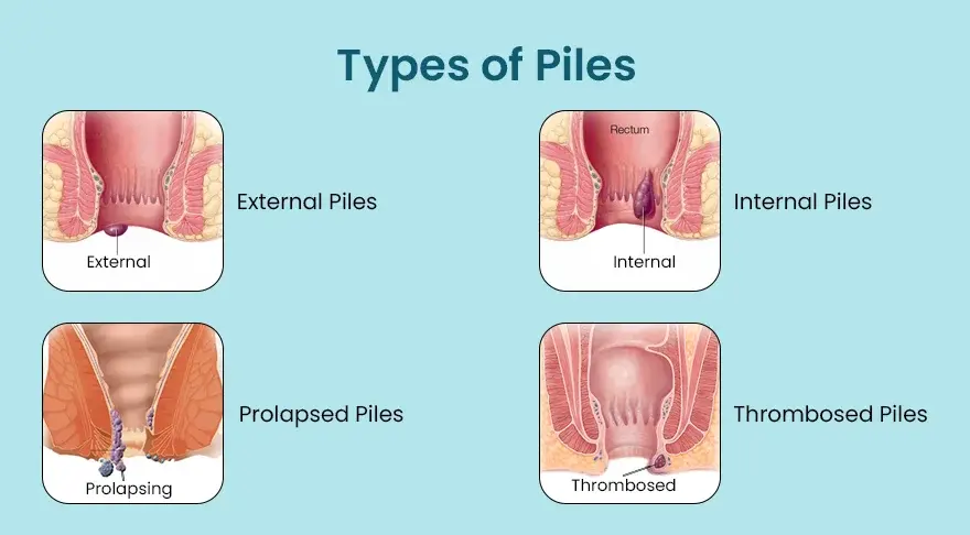 types of piles
