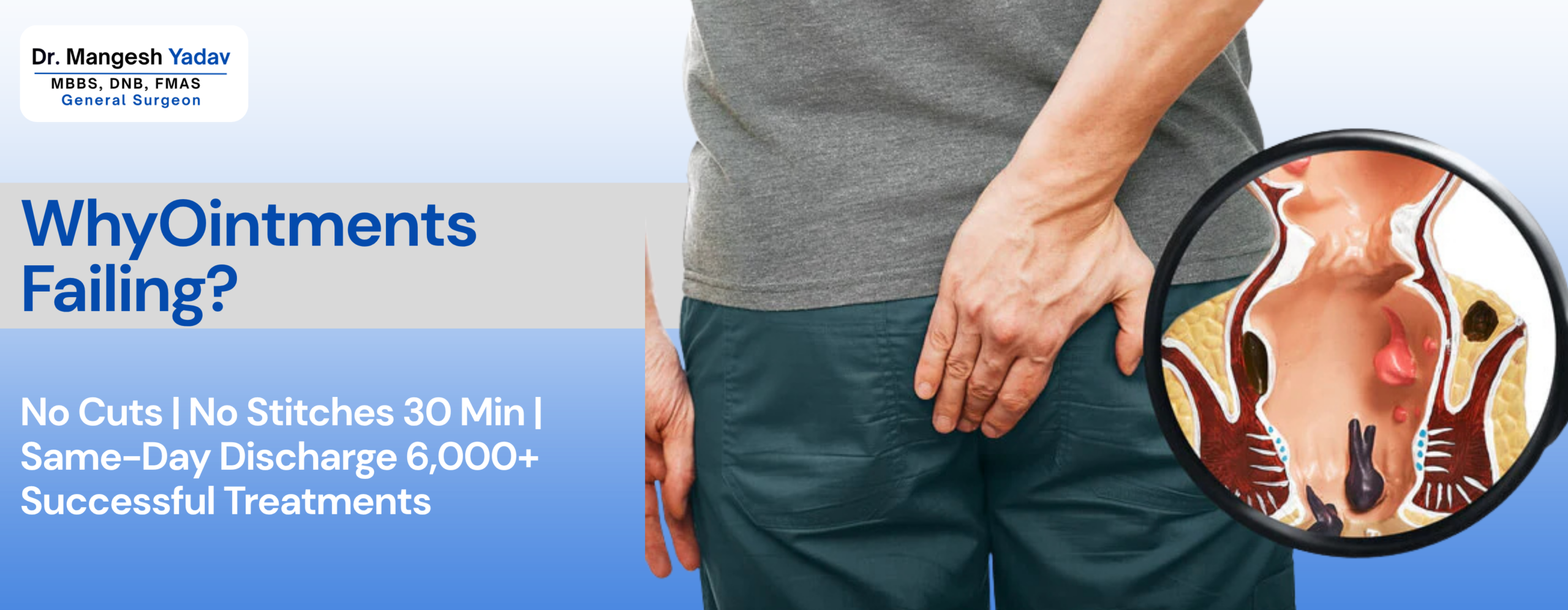 What Are Piles — And Why Do Ointments Keep Failing?