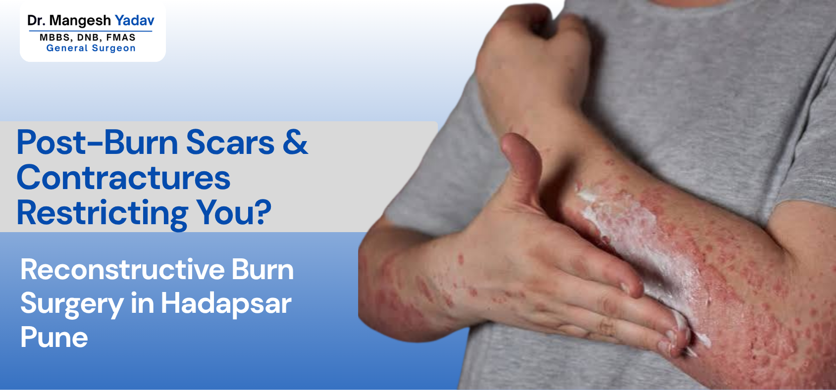 Overcoming Post-Burn Scars and Contractures: Reconstructive Burn Surgery in Hadapsar