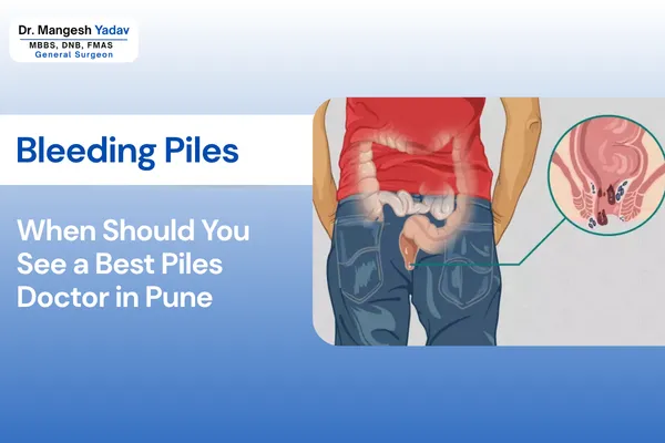 Bleeding Piles treatment in Pune