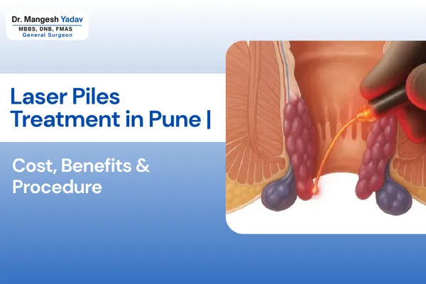 Laser Piles Treatment in Hadapsar Pune