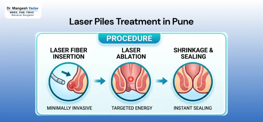 Laser Piles Treatment in Pune