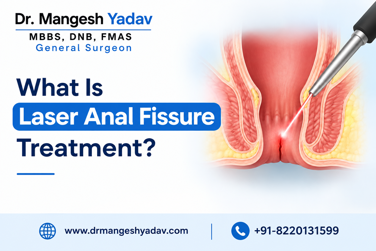 Laser Anal Fissure Treatment